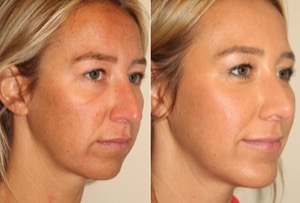 Dr. Denton Rhinoplasty before and after photo of a female patient