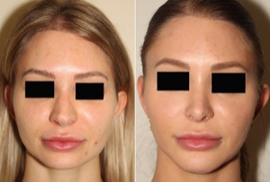 Dr. Denton Rhinoplasty before and after photo of a female patient