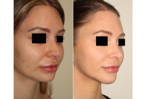 Dr. Denton Rhinoplasty before and after photo of a female patient