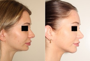 Dr. Denton Rhinoplasty before and after photo of a female patient