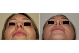 Dr. Denton Rhinoplasty before and after photo of a female patient