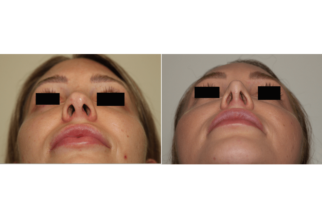 Dr. Denton Rhinoplasty before and after photo of a female patient