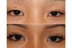 Dr. Denton Asian blepharoplasty before and after photo of a female patient