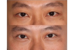 Dr. Denton Asian blepharoplasty before and after photo of a male patient