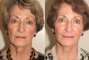 Dr. Denton facelift before and after photo of a female patient