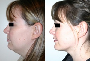 Dr. Denton chin implant before and after photo of a female patient