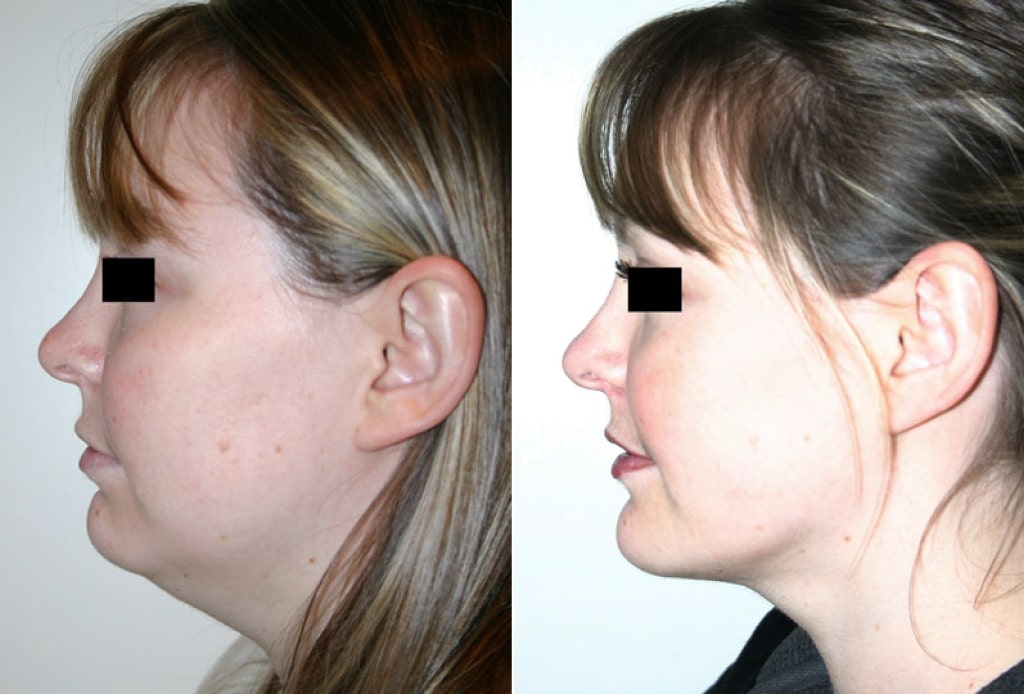 Dr. Denton chin implant before and after photo of a female patient