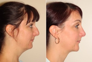 Dr. Denton liposuction and chin implant before and after photo of a female patient