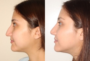 Dr. Denton Rhinoplasty before and after photo of a female patient