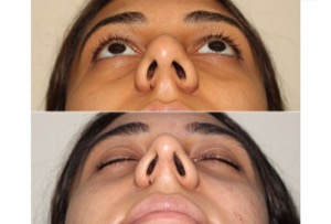 Dr. Denton Rhinoplasty before and after photo of a female patient