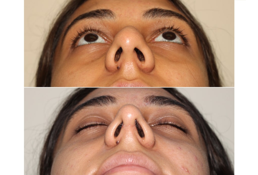 Dr. Denton Rhinoplasty before and after photo of a female patient