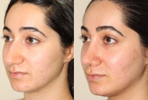 Dr. Denton Rhinoplasty before and after photo of a female patient