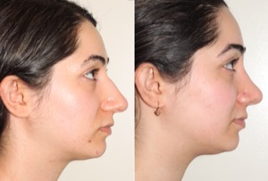 Dr. Denton Rhinoplasty before and after photo of a female patient