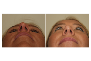 Dr. Denton Rhinoplasty before and after photo of a female patient