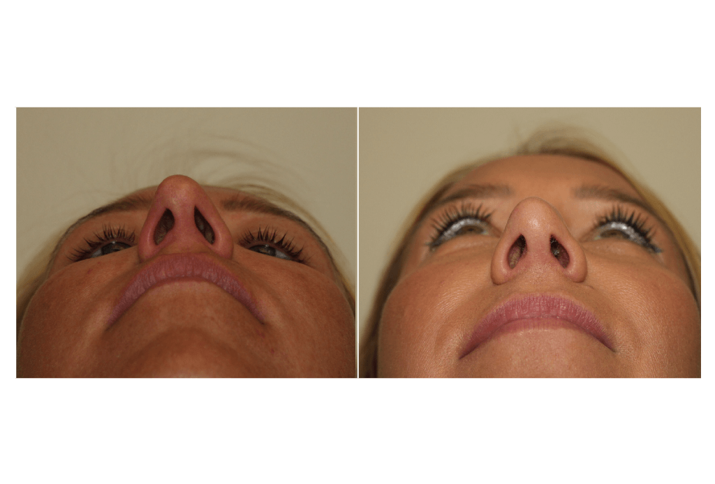 Dr. Denton Rhinoplasty before and after photo of a female patient