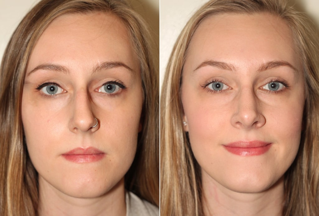 Dr. Denton Rhinoplasty before and after photo of a female patient