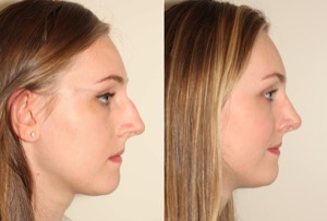 Dr. Denton Rhinoplasty before and after photo of a female patient