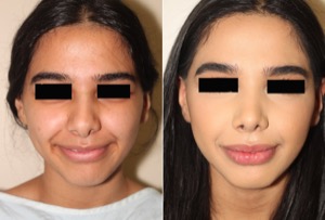 Dr. Denton Rhinoplasty before and after photo of a female patient