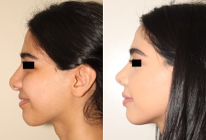 Dr. Denton Rhinoplasty before and after photo of a female patient