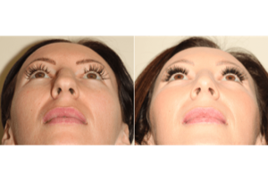Dr. Denton Rhinoplasty before and after photo of a female patient