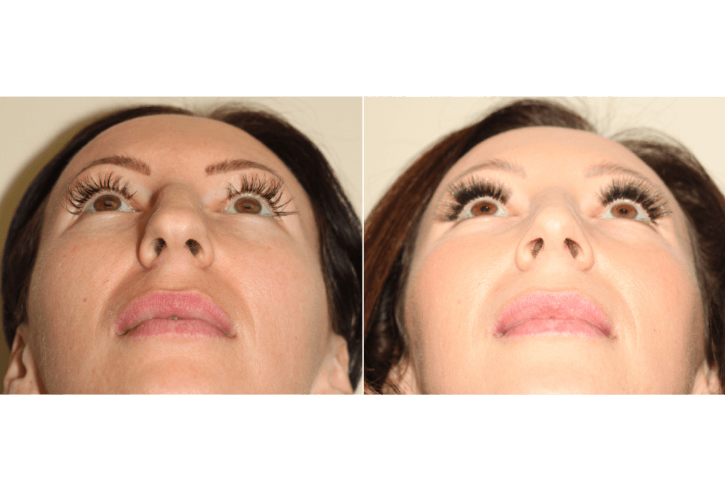 Dr. Denton Rhinoplasty before and after photo of a female patient