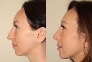 Dr. Denton Rhinoplasty before and after photo of a female patient