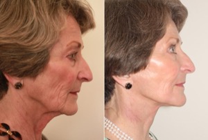 Dr. Denton facelift before and after photo of a female patient