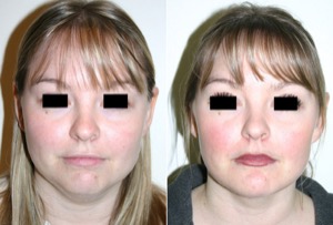 Dr. Denton chin implant before and after photo of a female patient