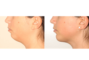 Dr. Denton liposuction and chin implant before and after photo of a female patient