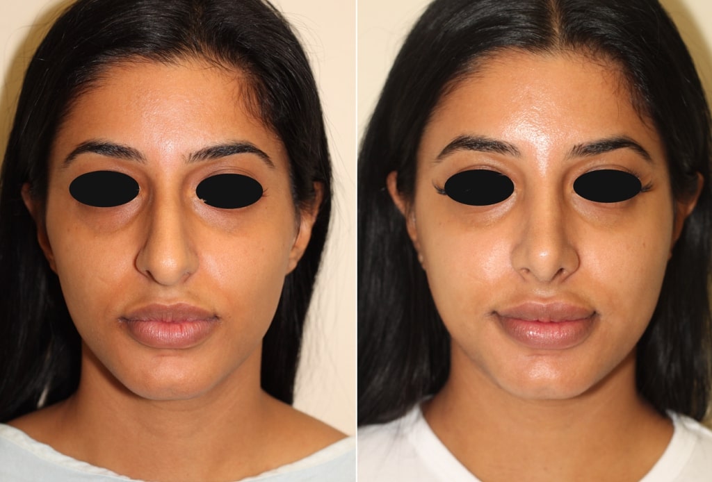 Dr. Denton Rhinoplasty before and after photo of a female patient