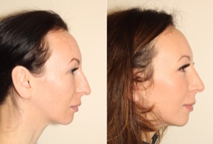Dr. Denton Rhinoplasty before and after photo of a female patient