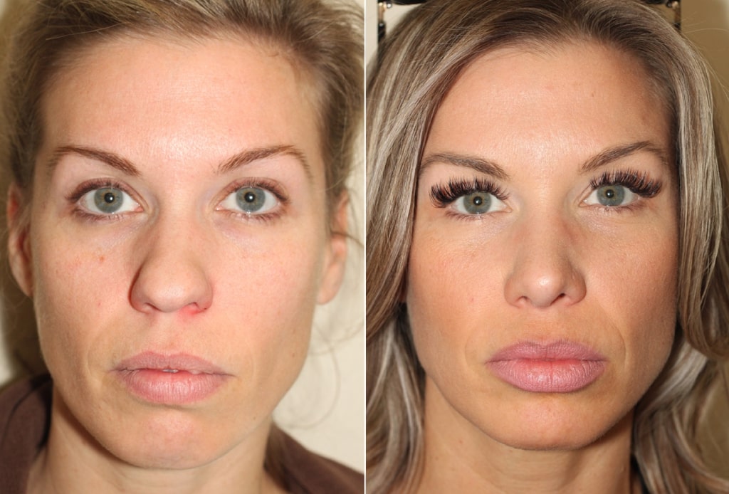 Dr. Denton Rhinoplasty before and after photo of a female patient