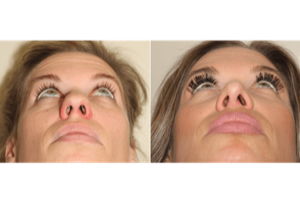Dr. Denton Rhinoplasty before and after photo of a female patient