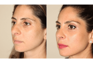 Dr. Denton Rhinoplasty before and after photo of a female patient