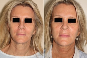 Dr. Denton facelift before and after photo of a female patient