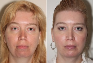 Dr. Denton chin implant before and after photo of a female patient