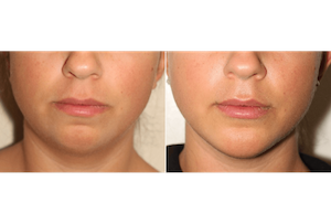 Dr. Denton liposuction before and after photo of a female patient