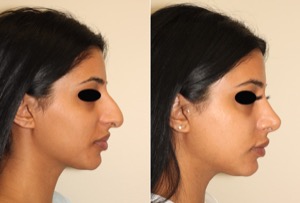 Dr. Denton Rhinoplasty before and after photo of a female patient