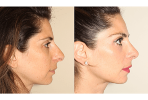 Dr. Denton Rhinoplasty before and after photo of a female patient