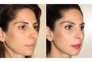 Dr. Denton Rhinoplasty before and after photo of a female patient