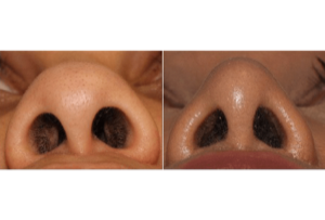 Dr. Denton Rhinoplasty before and after photo of a female patient