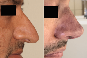 Dr. Denton Rhinoplasty before and after photo of a male patient