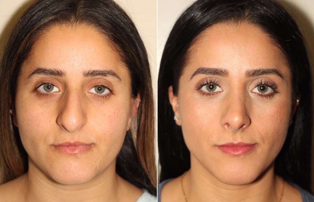 Only 2 Steps!! How to Lift your nose tip, Reshape your nose tip up naturally