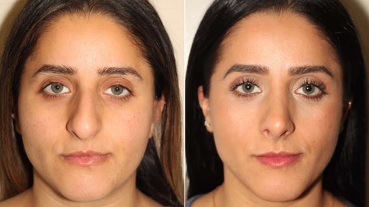 The Importance of Skin Thickness in Rhinoplasty