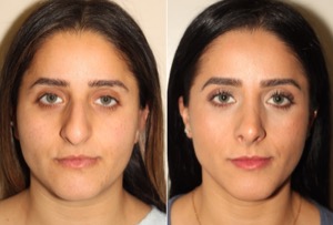 Dr. Denton Rhinoplasty before and after photo of a female patient