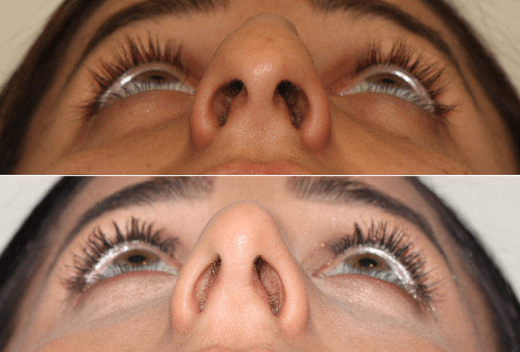 Dr. Denton Rhinoplasty before and after photo of a female patient