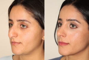 Dr. Denton Rhinoplasty before and after photo of a female patient