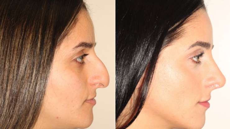 A Natural – Looking Nose Job in Vancouver