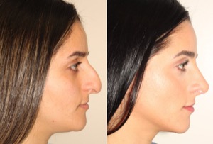 Dr. Denton Rhinoplasty before and after photo of a female patient