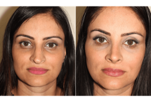 Dr. Denton Rhinoplasty before and after photo of a female patient